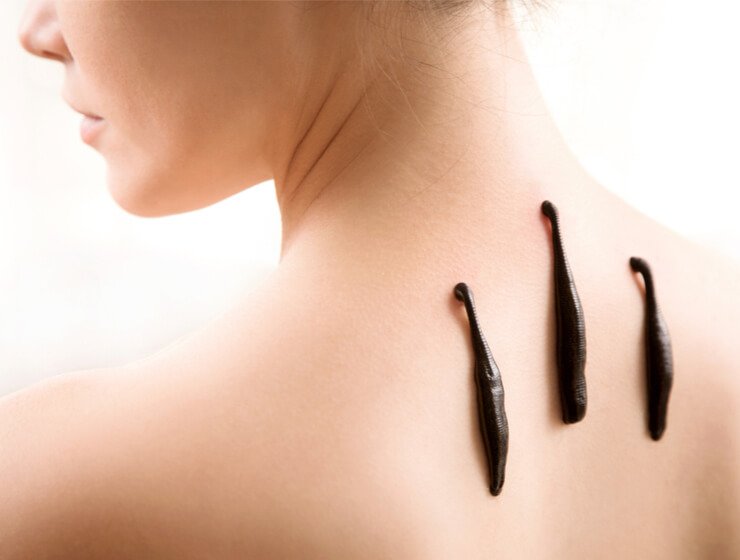 Hirudoterapia- terapia pijawkami