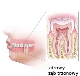 bco-to-jest-leczenie-kanaowe-endodontyczneb-42726