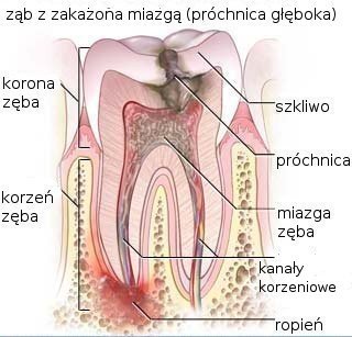 bco-to-jest-leczenie-kanaowe-endodontyczneb-42726
