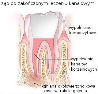 bco-to-jest-leczenie-kanaowe-endodontyczneb-42726