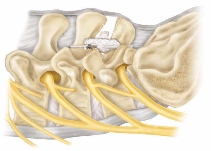 maoinwazyjna-neurochirurgia-kregosupa-techniki-operacyjne-w-dyskopatii-62498
