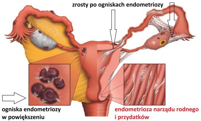 endometrioza-plaga-modych-kobiet-63433